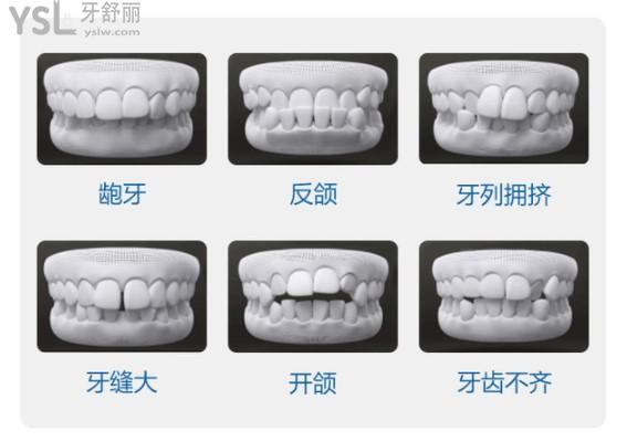 需要牙齿矫正的几种类型