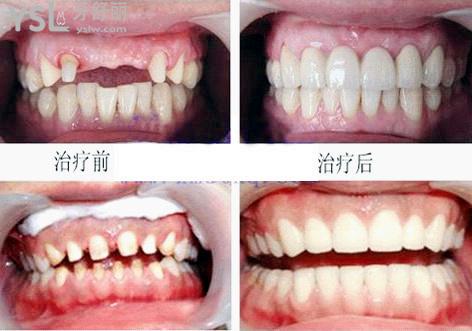 全瓷牙治疗成效参考
