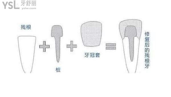67科普牙根剩多少可以打桩做单冠让你秒懂牙根打桩带冠治疗过程图解