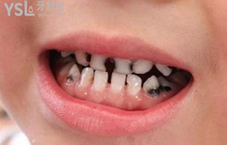 小孩子蛀牙怎么办?要不要治疗?