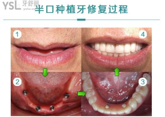 半口种植牙修复过程