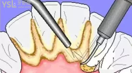 牙齿治疗配图