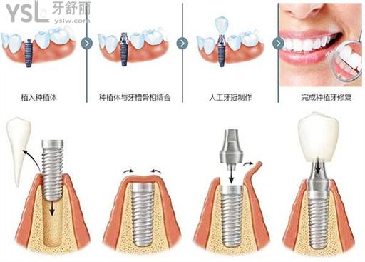 种植牙三期戴牙流程图片