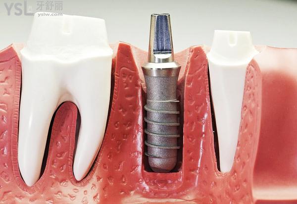 牙缺失十几年了能种植牙吗？