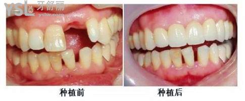 种植牙是真牙还是假牙？