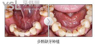 广州雅度口腔医院种牙好吗