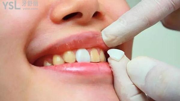 贴面需要磨牙吗，做贴面对牙齿有伤害吗？答案都在这
