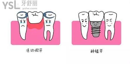 镶牙和种牙有什么区别哪个好?