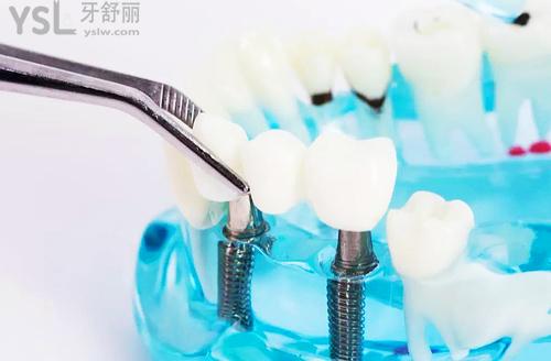 2022做一颗种植牙多少钱?收好这份北京/上海/广州医院牙科收费价目表避坑!