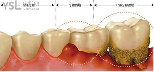 牙龈萎缩导致老年人牙齿掉了一部分