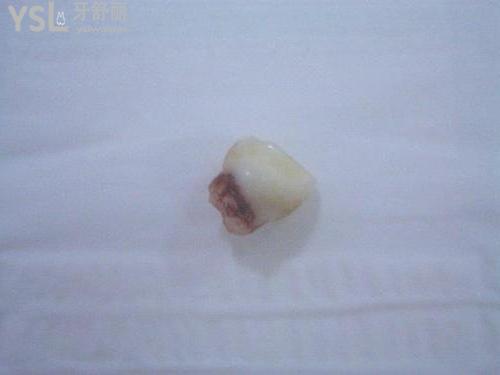 牙掉了**时间该怎么处理？我劝你赶紧去医院