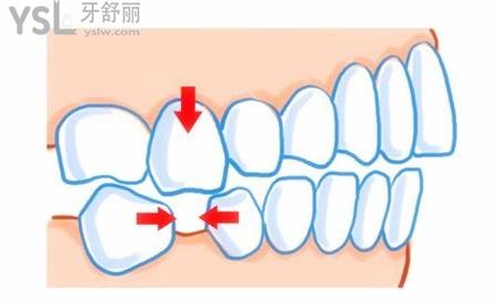 长期缺牙不管导致牙缝大