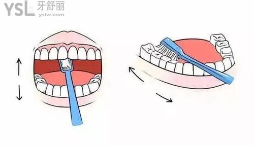 错误刷牙方法导致牙缝大