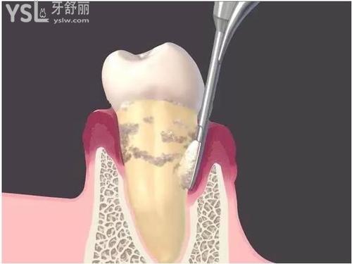 牙周治疗预防牙缝变大