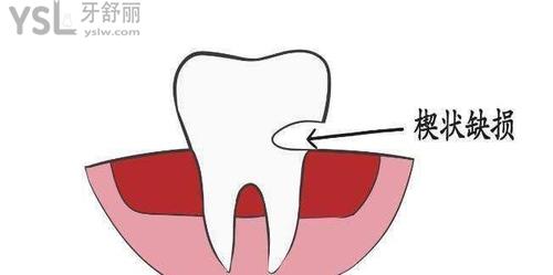 细数中年人牙齿容易烂是什么原因3