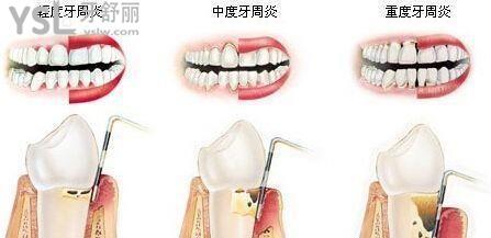 细数中年人牙齿容易烂是什么原因5