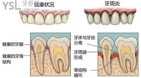 牙齿疾病造成牙缝变大