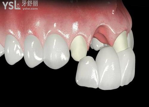 固定假牙种类及价格及特点