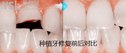 牙齿被打断怎么修复
