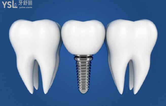 种植牙