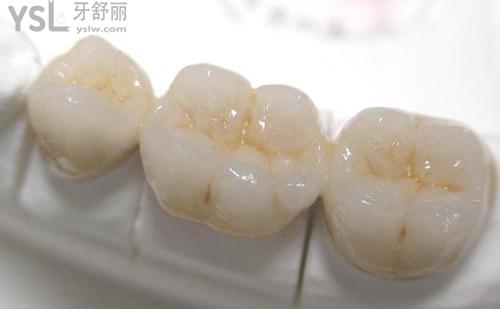 镶牙
