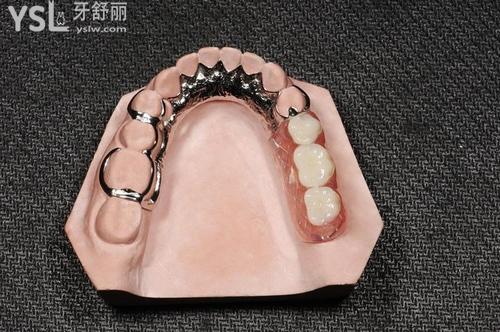 成人牙掉了可以做活动义齿