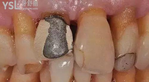 牙冠材料是烤瓷的好还是全瓷的好1