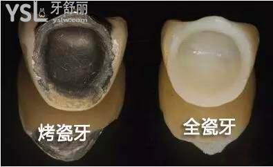 牙冠材料是烤瓷的好还是全瓷的好2