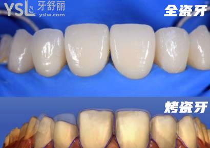 牙冠材料是烤瓷的好还是全瓷的好4