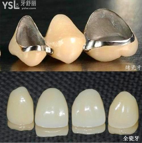 牙冠材料是烤瓷的好还是全瓷的好5