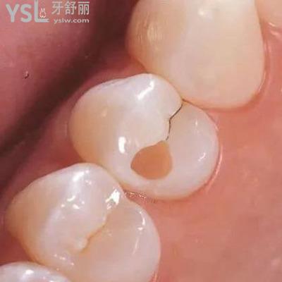 蛀牙蛀到牙神经要怎么治疗
