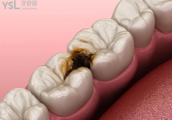 牙缝细菌通过超声波洗牙