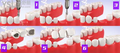 牙冠修复过程图解