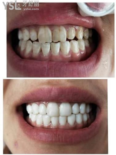 门牙缺角想要做贴面,瓷贴面好还是树脂贴面好,知道的来唠唠区别
