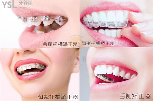 四种牙齿矫正方法及差别