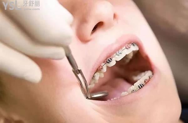 固定牙齿矫正器