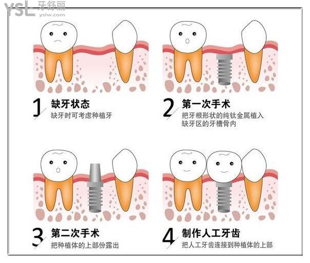 种植牙修复过程图