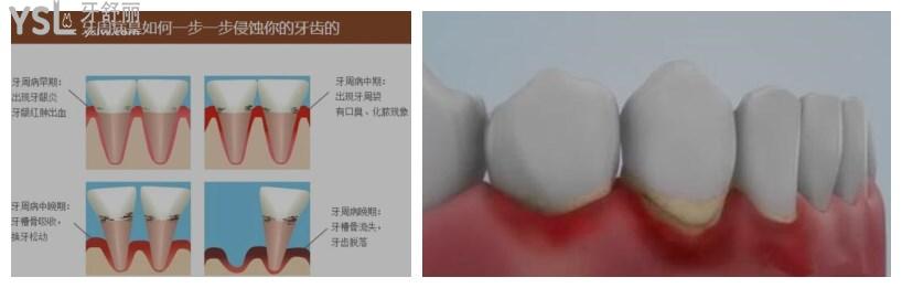 牙周炎和牙龈炎的根本区别