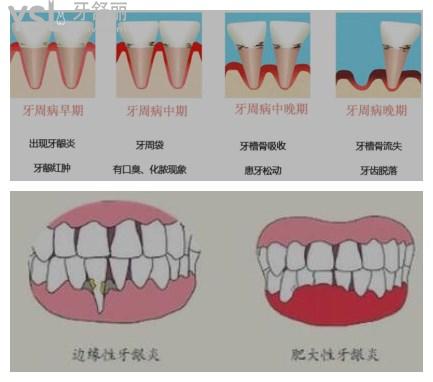 牙周炎和牙龈炎的根本区别是什么这篇告诉你答案