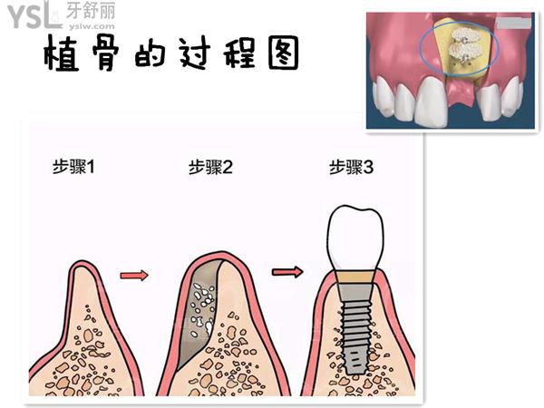 种植牙植骨过程图