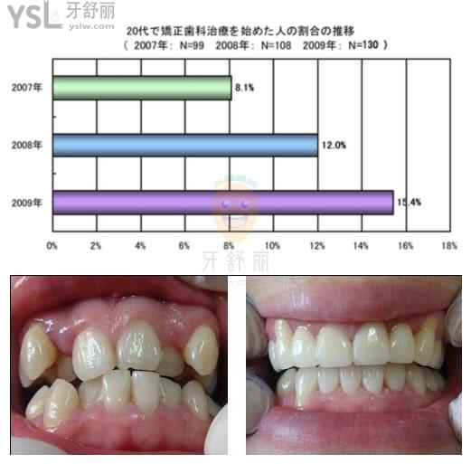 日本人为什么不矫正牙齿，牙齿乱为什么却很少正畸