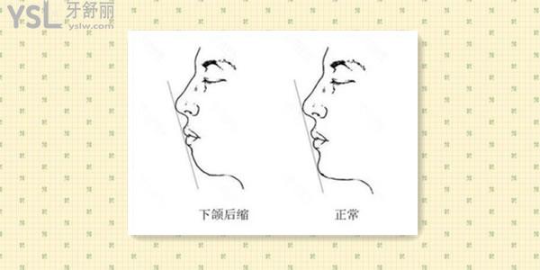 整牙能改善下巴后缩吗.jpg