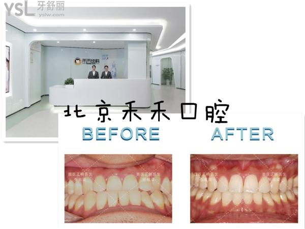 北京禾禾口腔对比事例