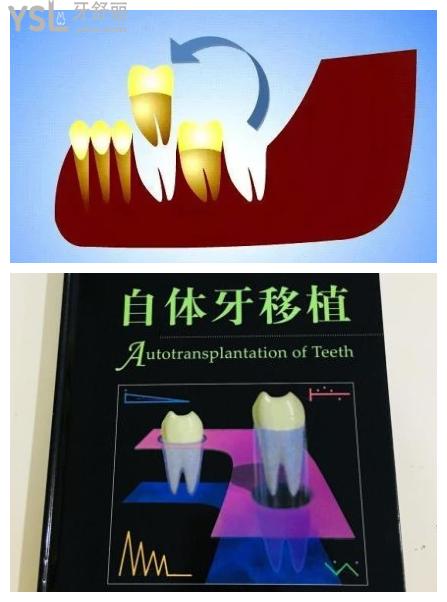 自体牙移植术