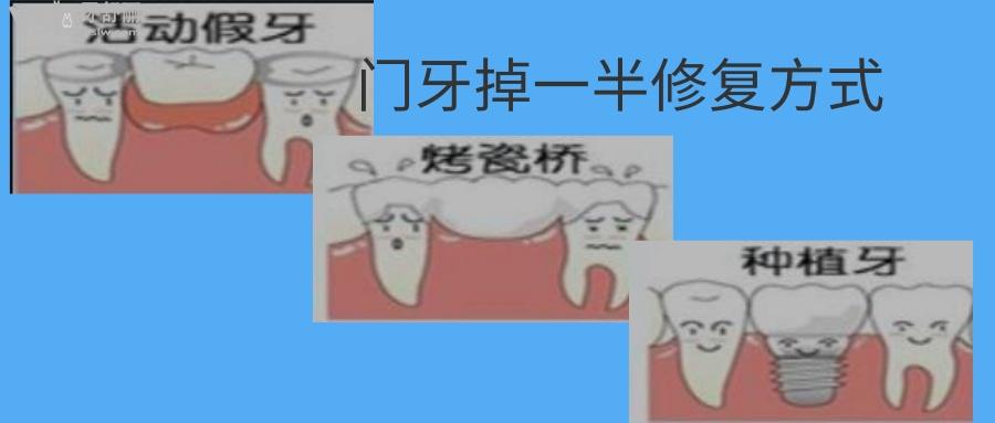 门牙掉一半修复多少钱