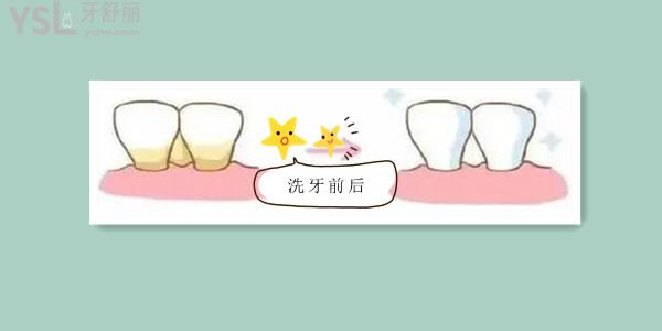 淘宝上的牙结石去除器有用吗