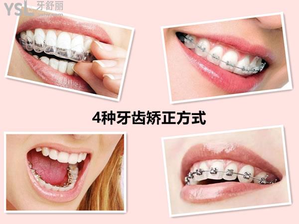牙齿矫正的几种方式