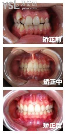 牙齿矫正成效图