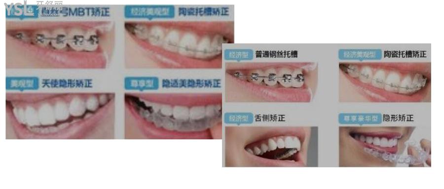 学生牙齿矫正大概要多少钱