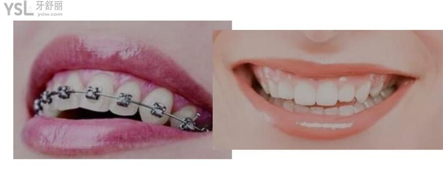 学生牙齿矫正大概要多少钱